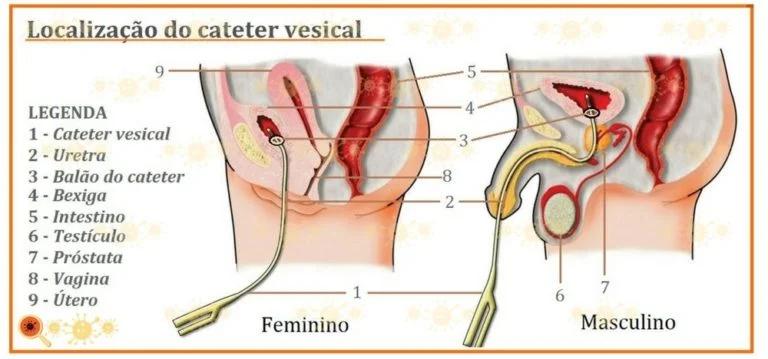 cateterismo-vesical-768x359