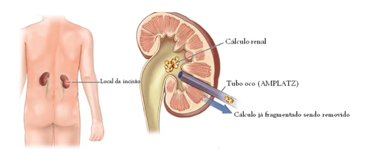 cirurgia-renal-percutanea-768x337