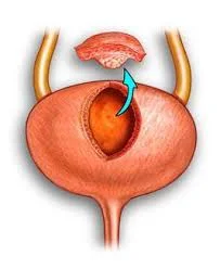 cistectomia-parcial