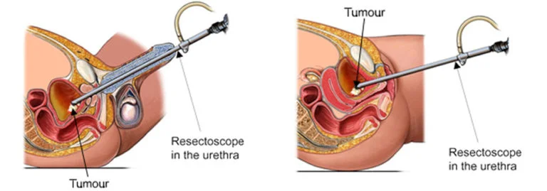 RESSECÇÃO TRANSURETRAL DE TUMOR VESICAL